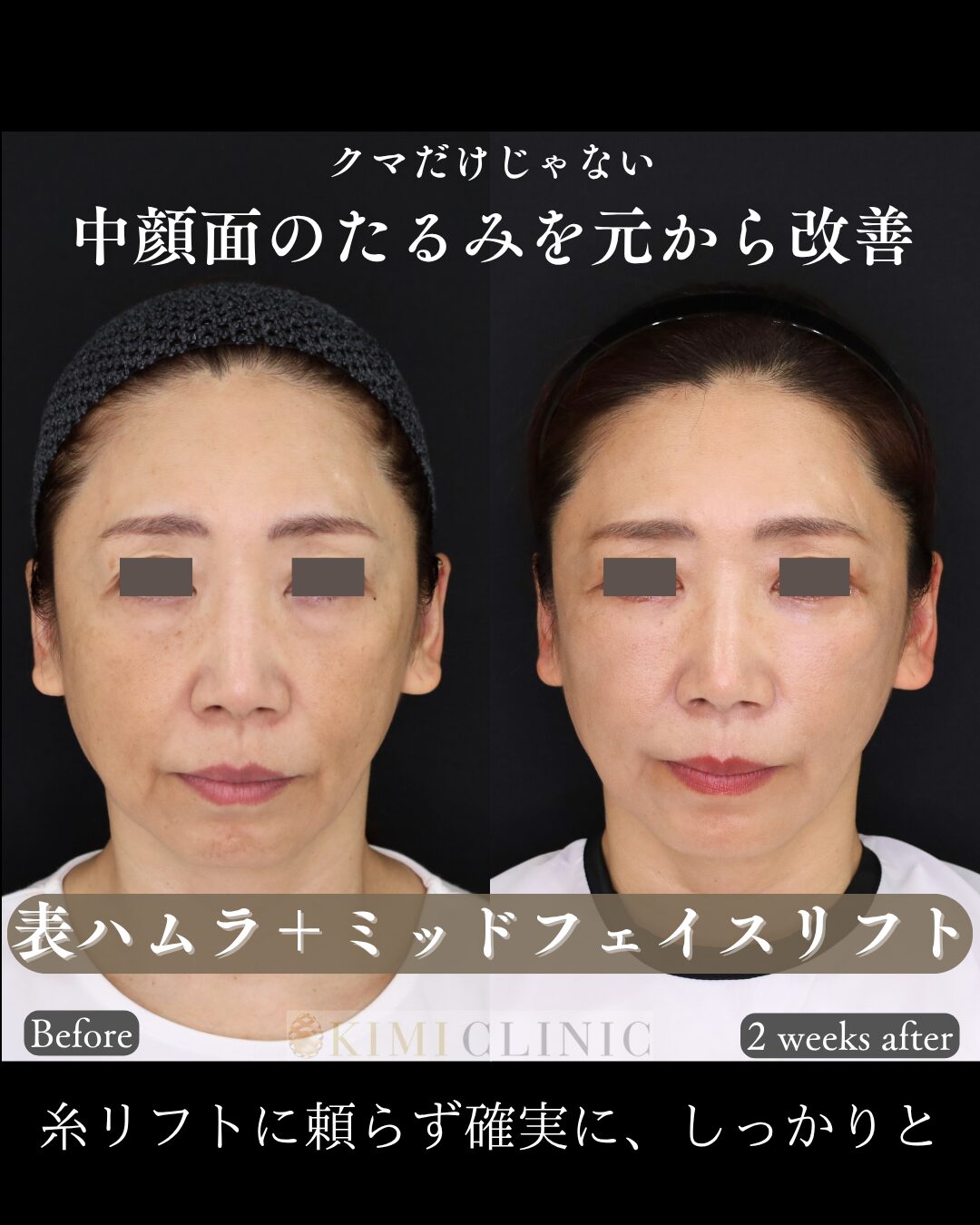「表ハムラ × ミッドフェイス（中顔面）リフト」の術前・術後比較Before写真