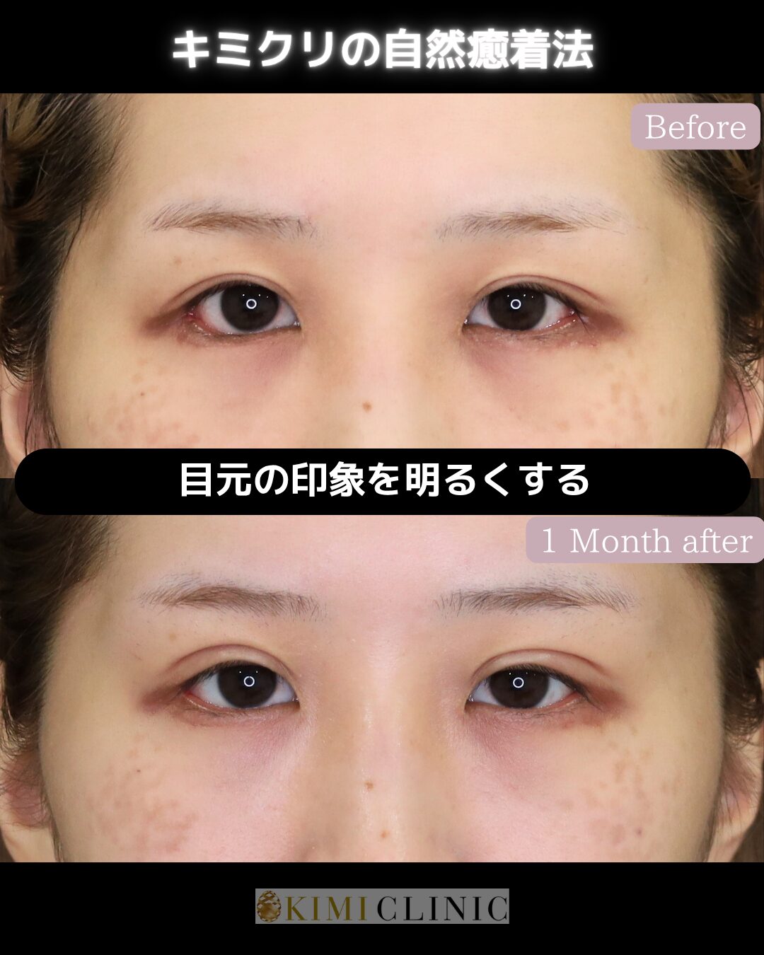 「キミクリの自然癒着法」の術前・術後比較Before写真