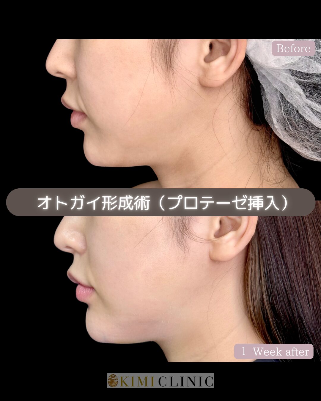 「オトガイ（顎）のプロテーゼ挿入」の術前・術後比較Before写真