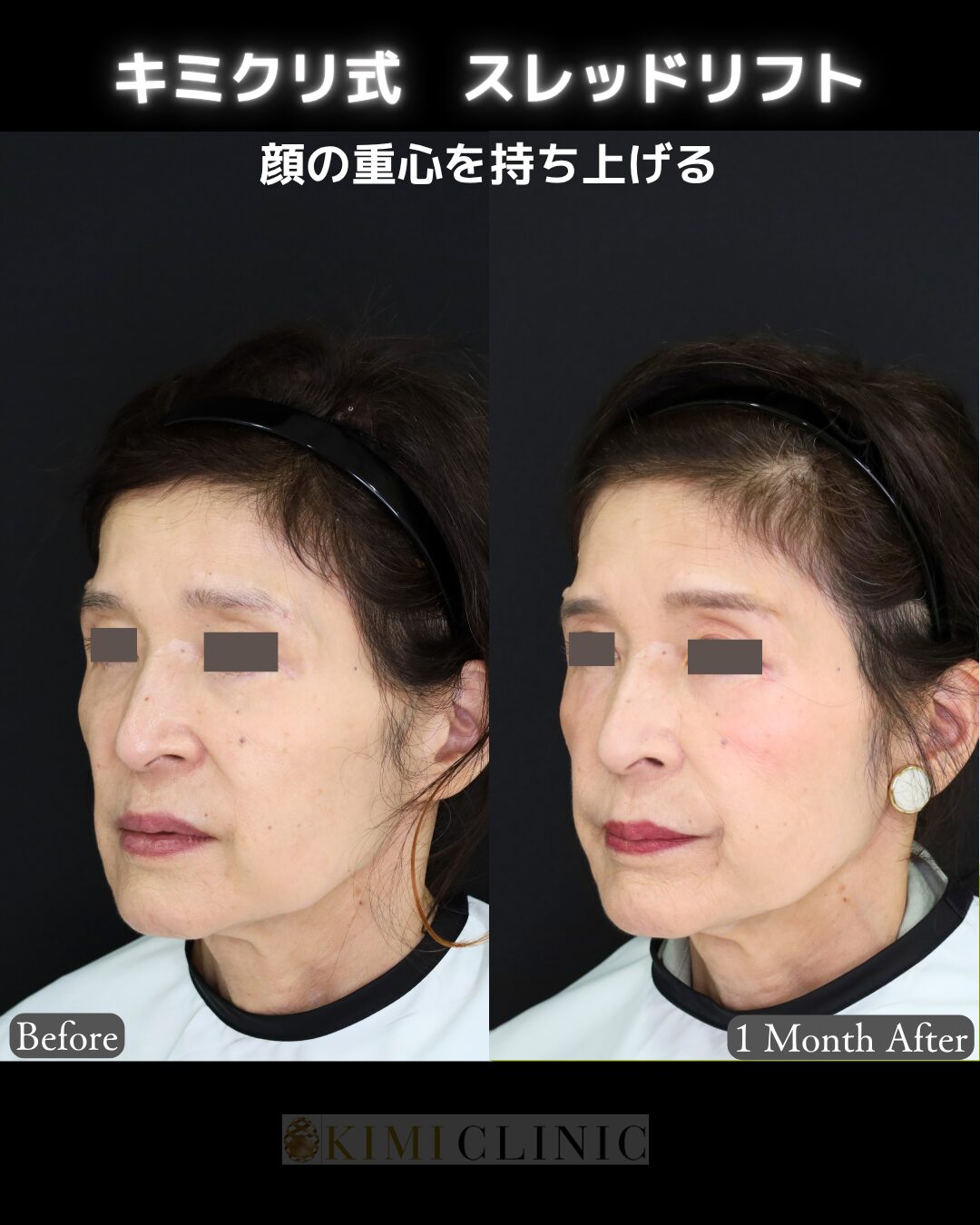 「キミクリ式糸リフト」の術前・術後比較Before写真