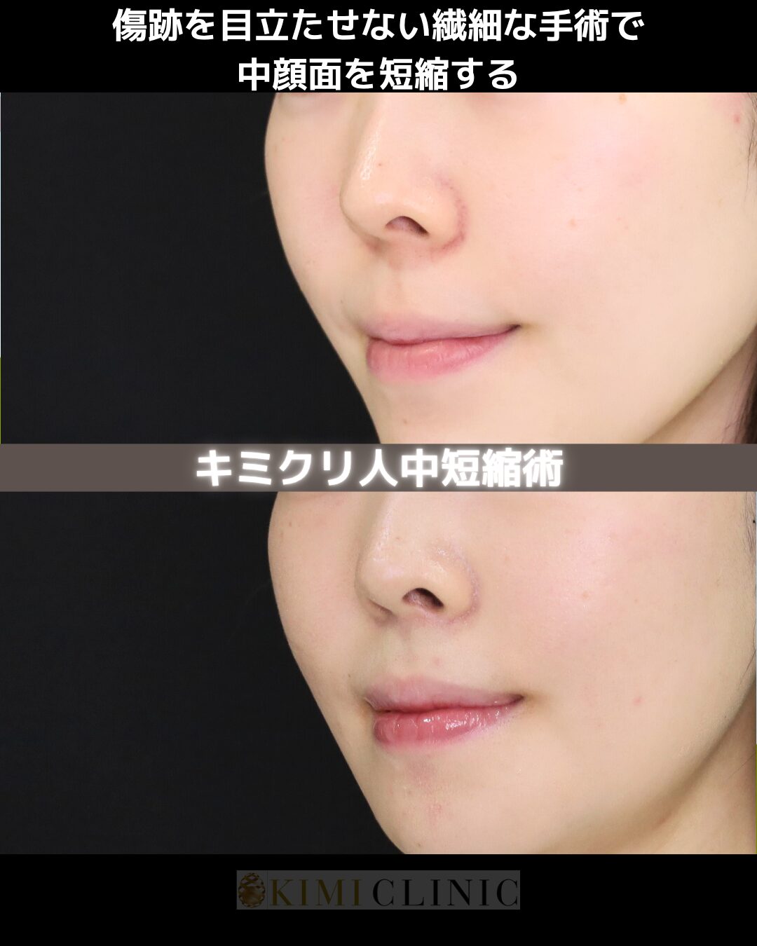 「人中短縮」の術前・術後比較Before写真