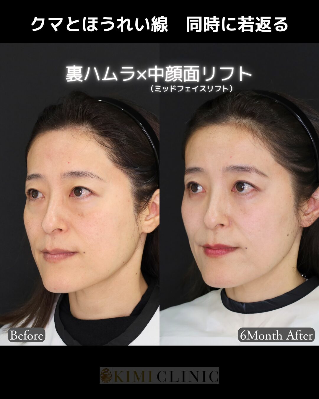 「裏ハムラ × 中顔面（ミッドフェイス）リフト」の術前・術後比較Before写真