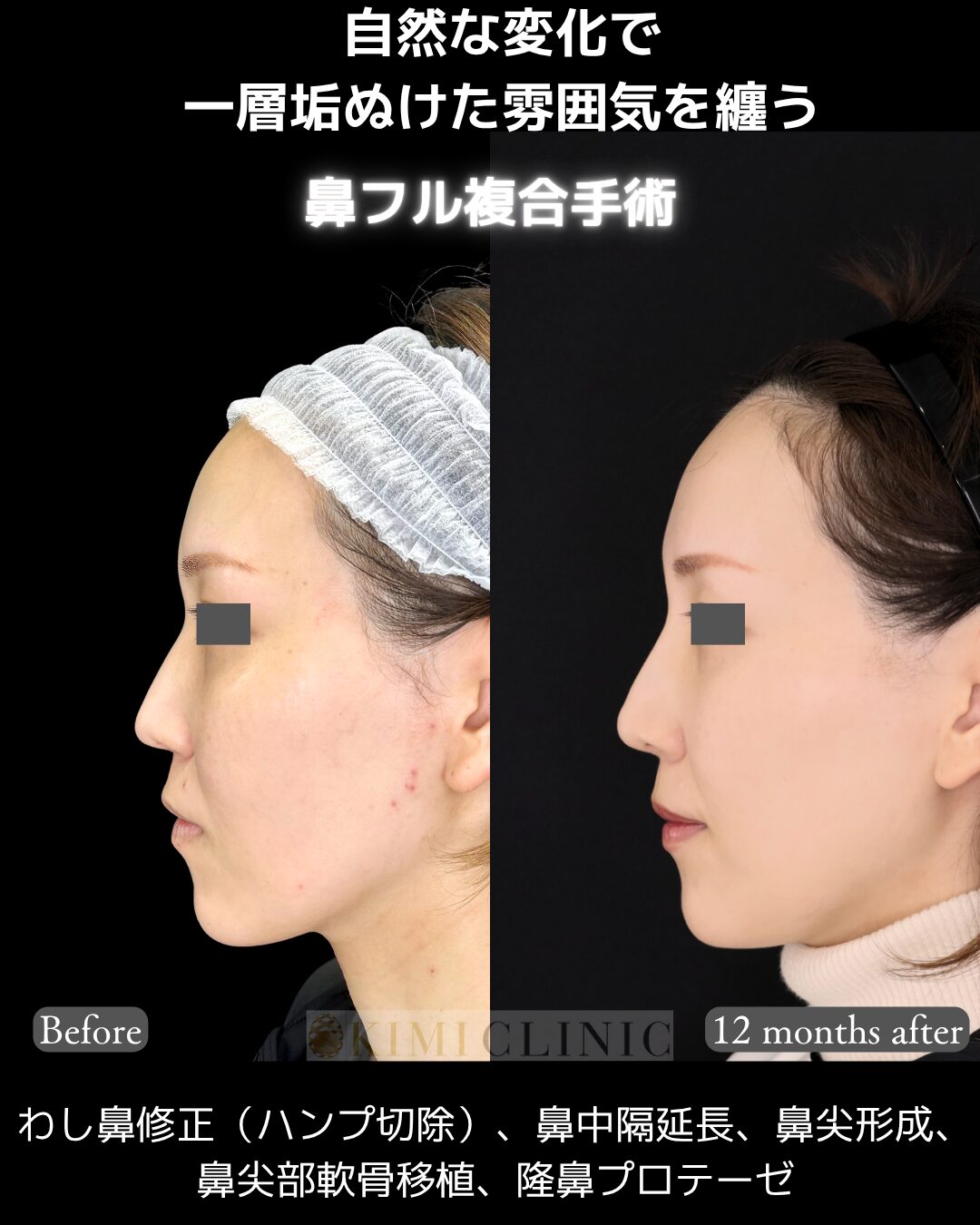 「鼻フル複合手術」の術前・術後比較Before写真