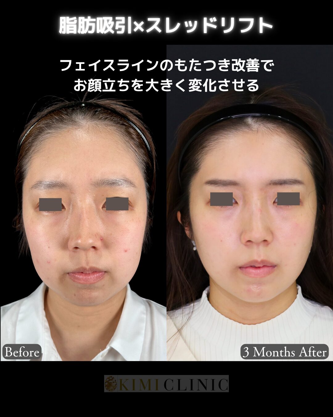 「サクションリフト（脂肪吸引×糸リフト）」の術前・術後比較Before写真