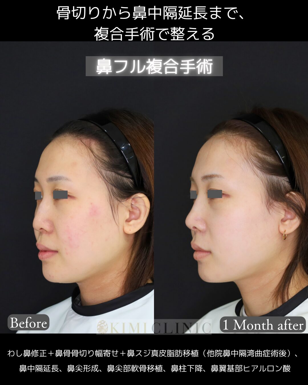 「鼻フル複合手術」の術前・術後比較Before写真