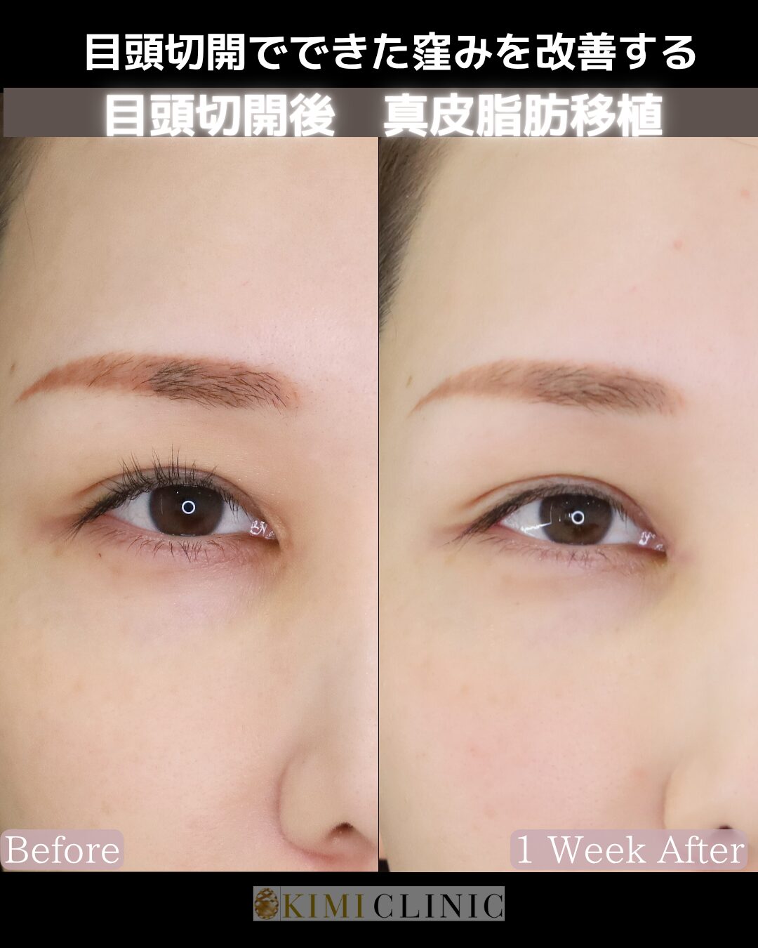 「目頭形成（目頭切開後の窪み改善）・真皮脂肪移植」の術前・術後比較Before写真