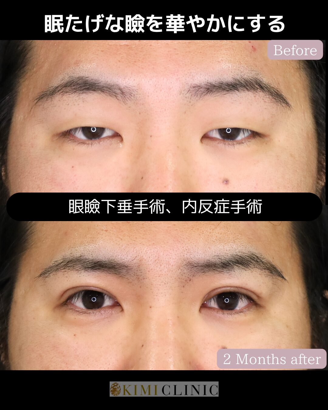「眼瞼下垂手術×内反症手術」の術前・術後比較Before写真