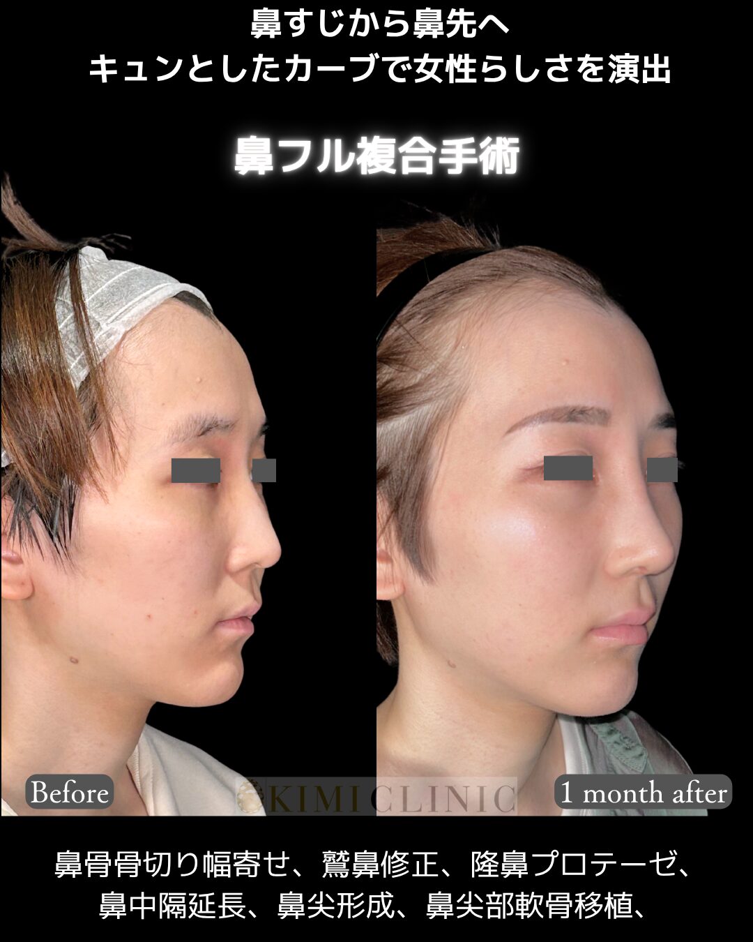 「鼻フル複合手術」の術前・術後比較Before写真