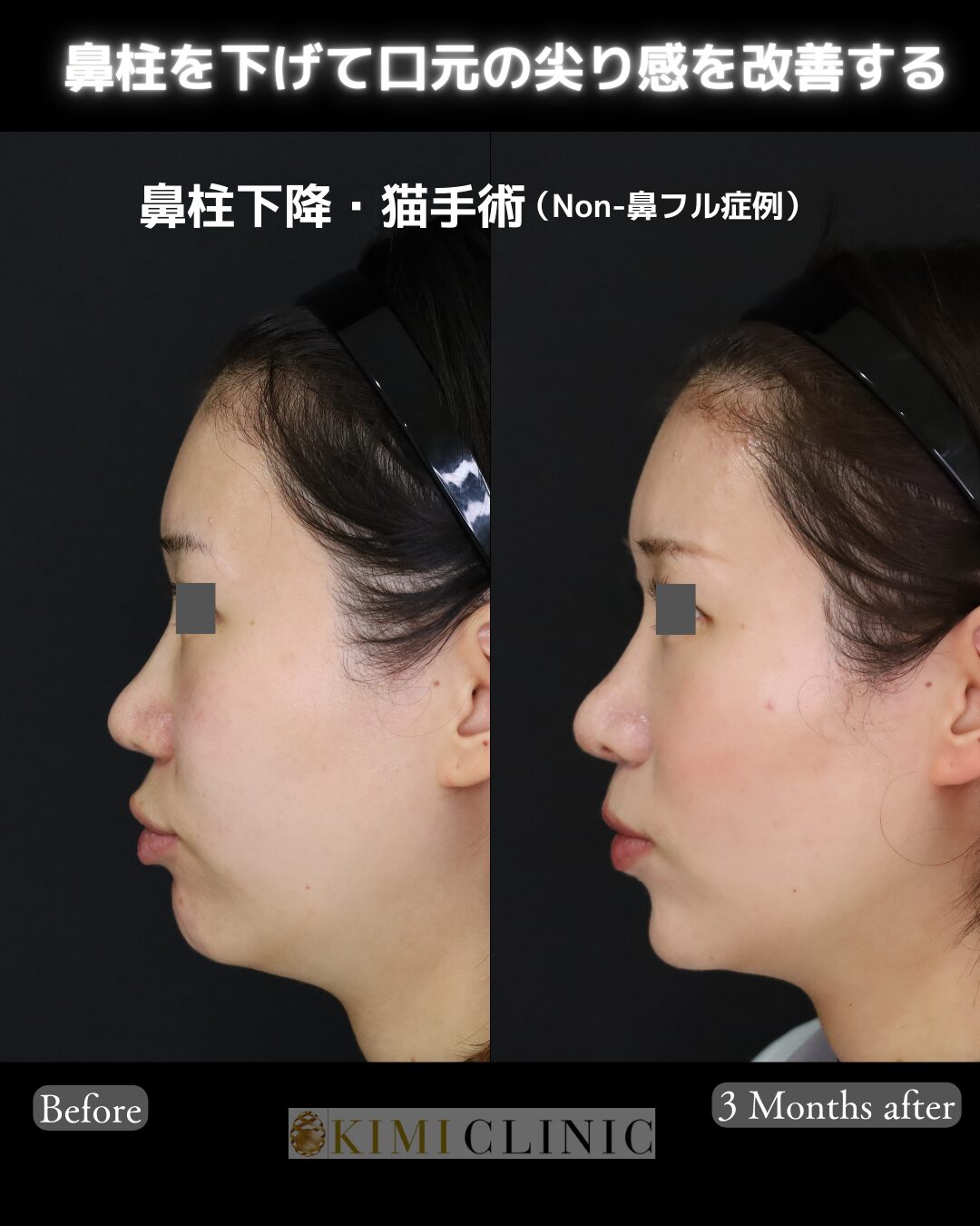 「鼻柱下降＆猫手術」の術前・術後比較Before写真