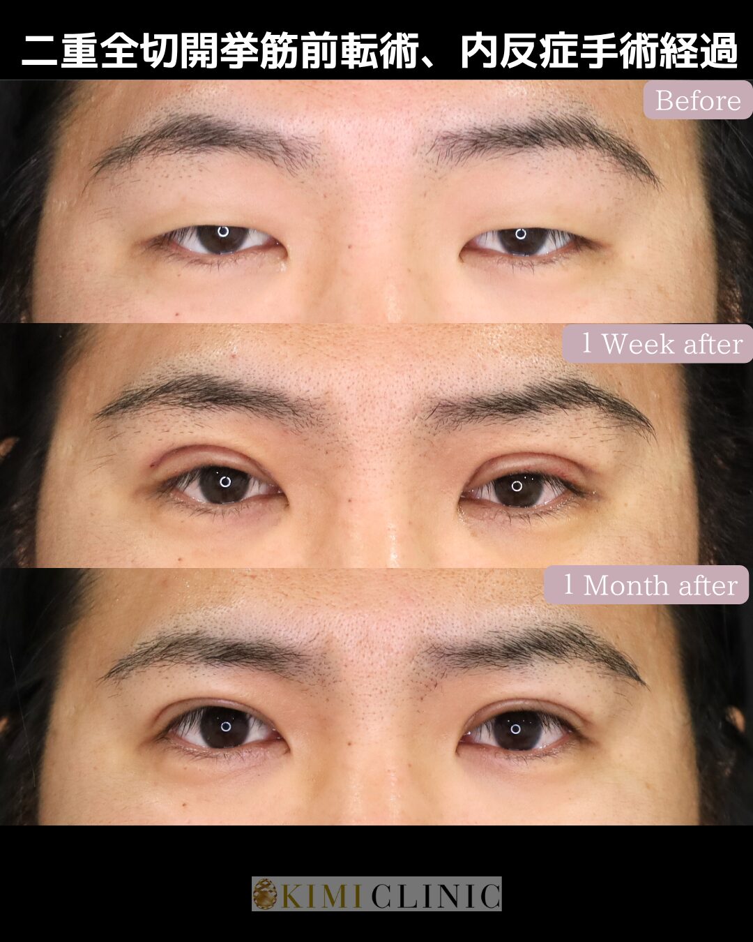 「眼瞼下垂手術×内反症手術」のダウンタイム経過Before写真