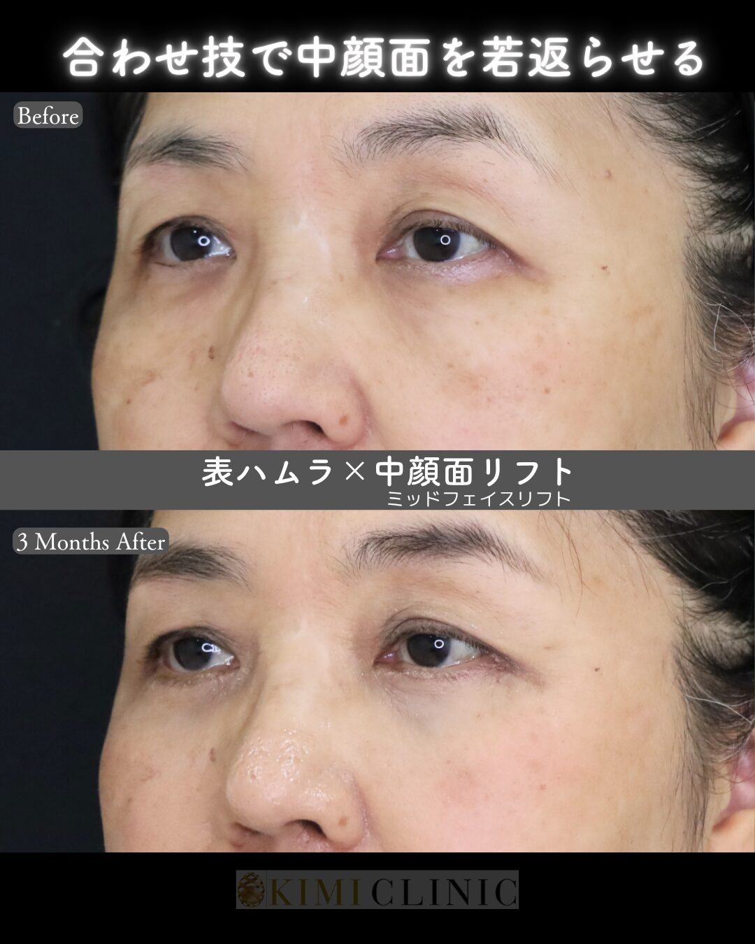 「表ハムラ × 中顔面（ミッドフェイス）リフト」の術前・術後比較Before写真