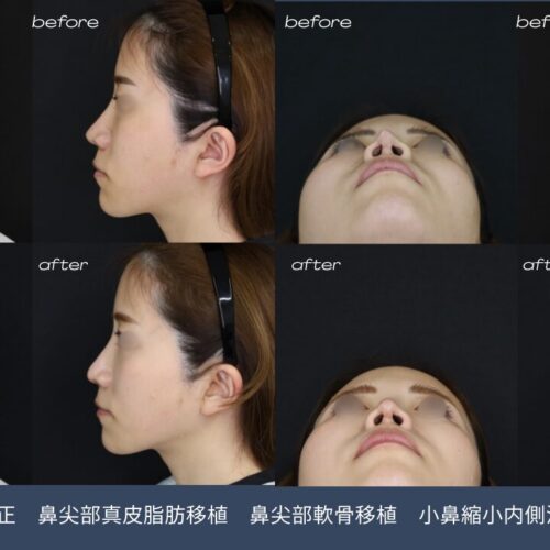 【鼻整形・症例解説】他院修正で後悔しないために |　形成外科専門医の治療プランと考え方