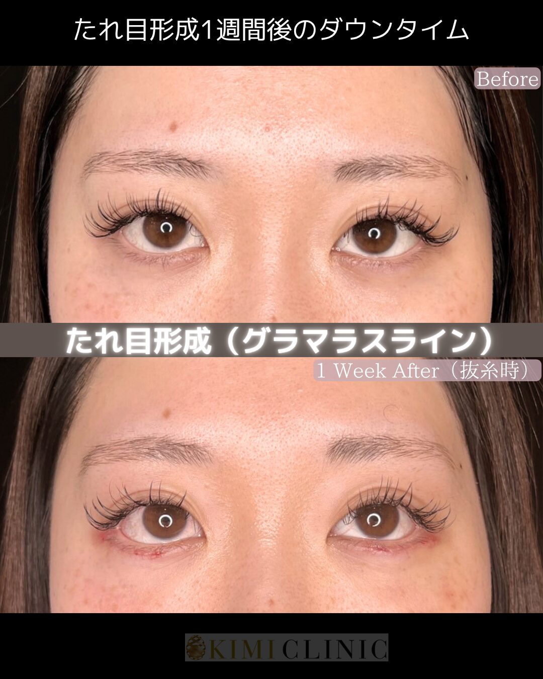 「たれ目形成（グラマラスライン）」の術後１週間後のダウンタイム経過Before写真