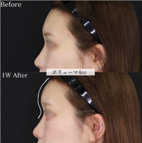 「額ヒアルロン酸」の術前・術後比較Before写真