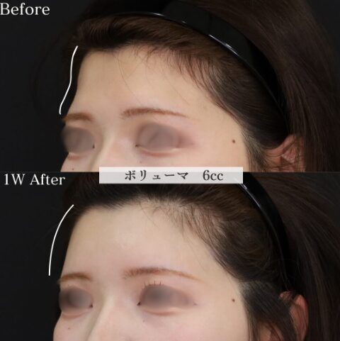 「額ヒアルロン酸」の術前・術後比較Before写真