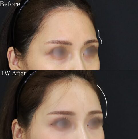 「額ヒアルロン酸」の術前・術後比較Before写真