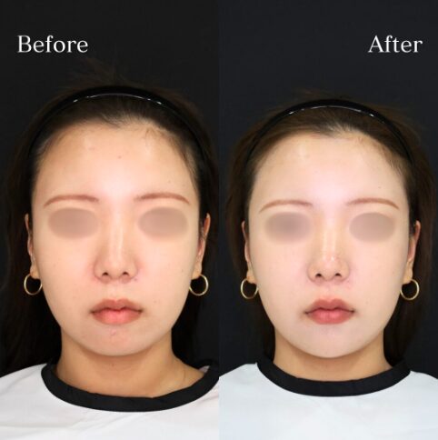 「あごヒアルロン酸」の術前・術後比較Before写真