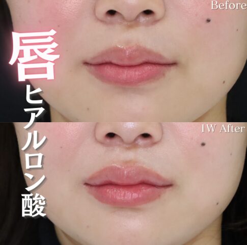 「唇ヒアルロン酸」の術前・術後比較Before写真