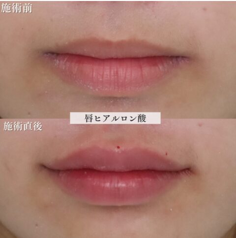 「唇ヒアルロン酸」の術前・術後比較Before写真