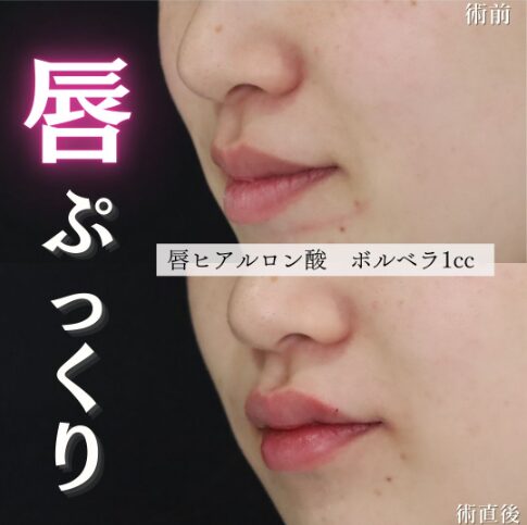「唇ヒアルロン酸」の術前・術後比較Before写真