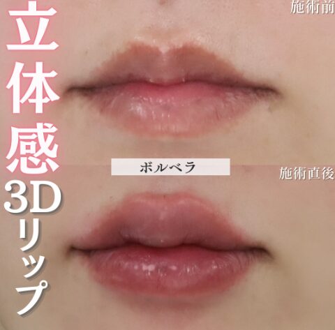 「唇ヒアルロン酸」の術前・術後比較Before写真