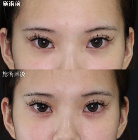 「涙袋ヒアルロン酸」の術前・術後比較Before写真