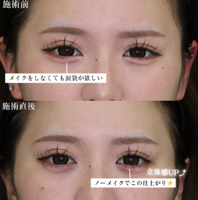 「涙袋ヒアルロン酸」の術前・術後比較Before写真