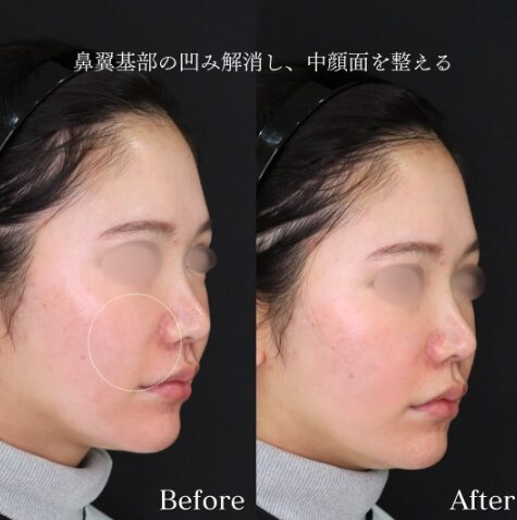 「鼻翼基部×チークトップヒアル」の術前・術後比較Before写真