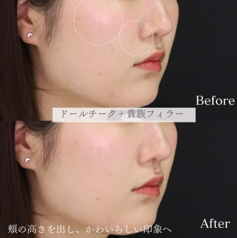 「鼻翼基部×チークトップヒアル」の術前・術後比較Before写真