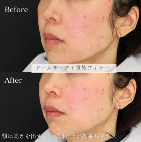 「鼻翼基部×チークトップヒアル」の術前・術後比較Before写真