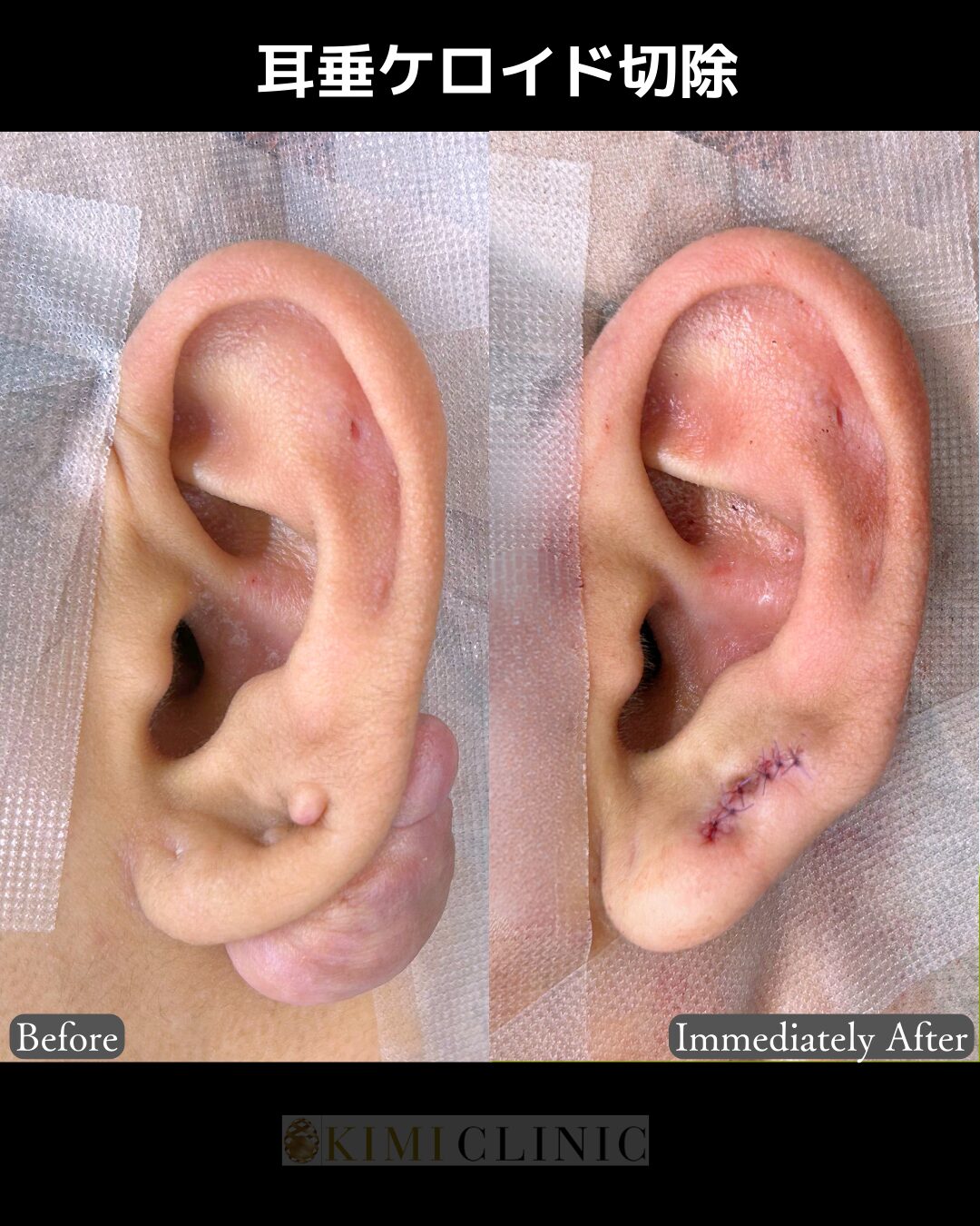 「耳垂ケロイド切除」の術前・術直後比較Before写真