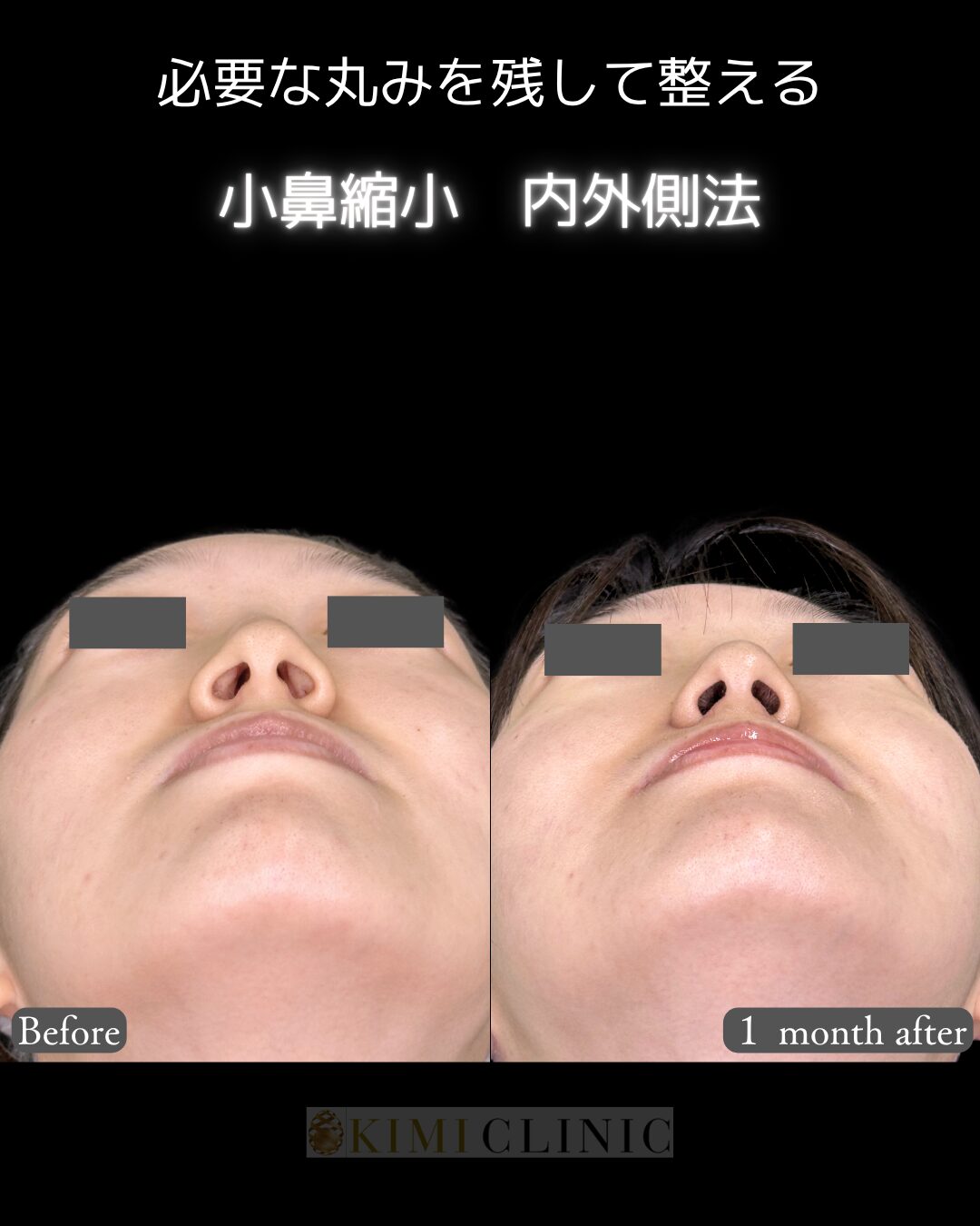 「小鼻縮小」の術前・術後比較Before写真