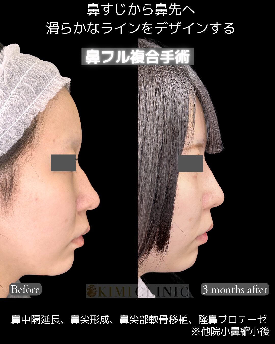 「鼻フル複合手術」の術前・術後比較Before写真