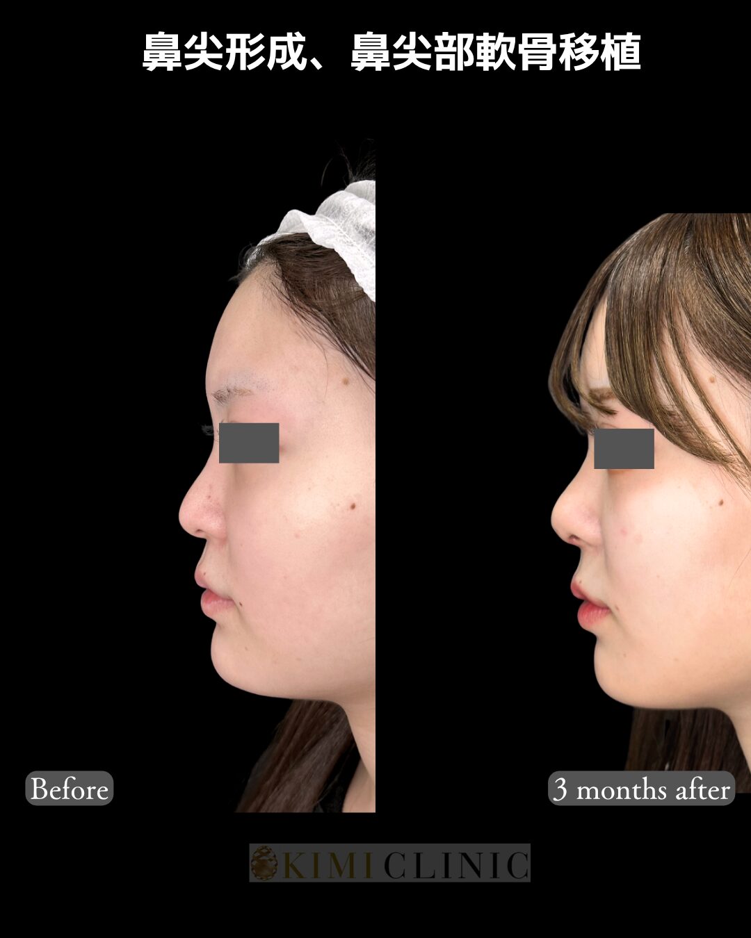 「鼻尖形成（ストラット法）＆ 鼻尖部軟骨移植」の術前・術後比較Before写真