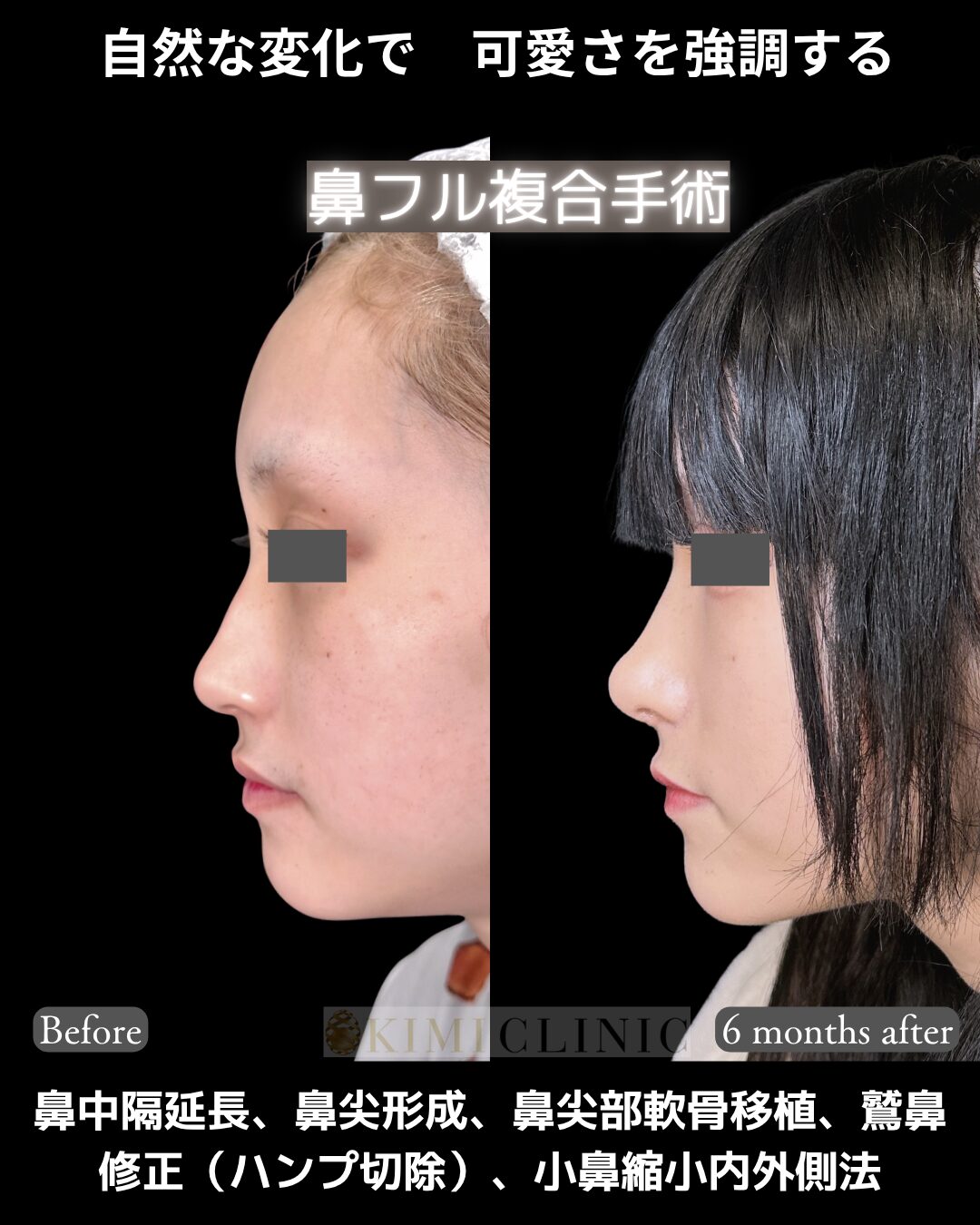 「鼻フル複合手術」の術前・術後比較Before写真