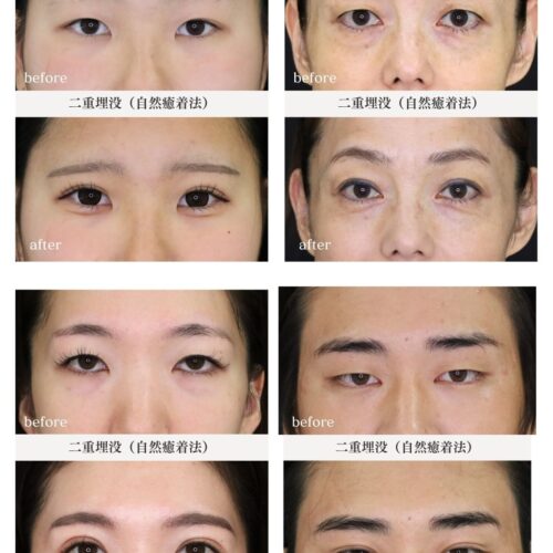 二重埋没症例集