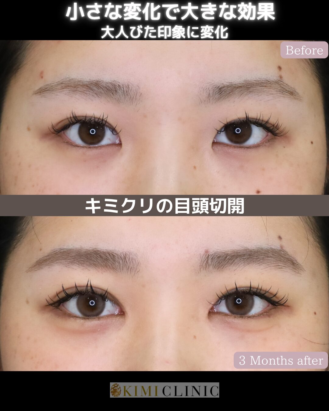 「目頭切開」の術前・術後比較Before写真