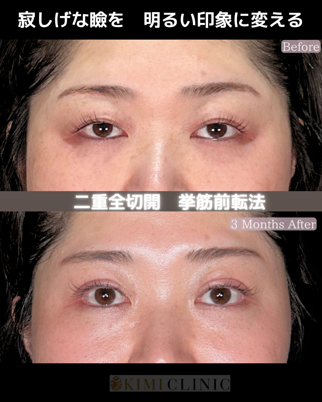 「眼瞼下垂手術」の術前・術後比較Before写真