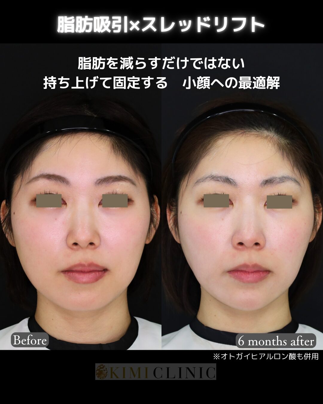 「サクションリフト（顔の脂肪吸引 × 糸リフト）」の術前・術後比較Before写真