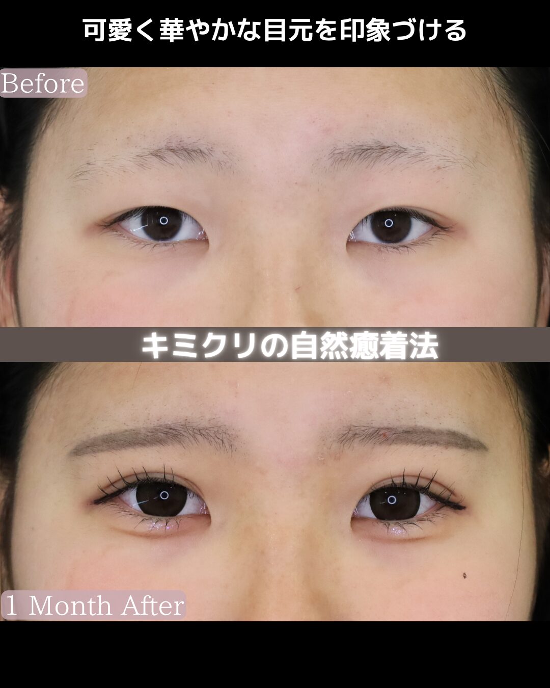 「キミクリの自然癒着法」の術前・術後比較Before写真