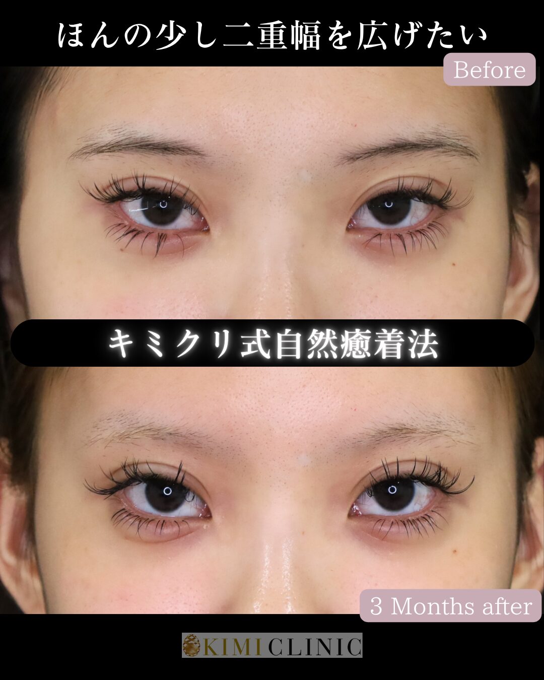 「キミクリの自然癒着法」の術前・術後比較Before写真