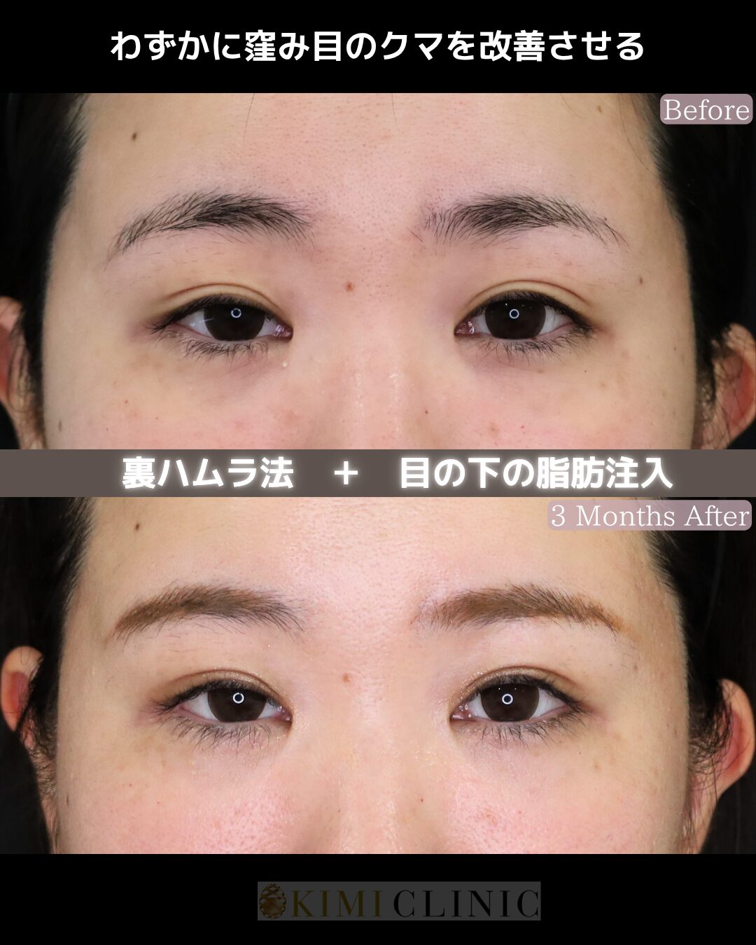 「裏ハムラ × 目の下の脂肪注入」の術前・術後比較Before写真