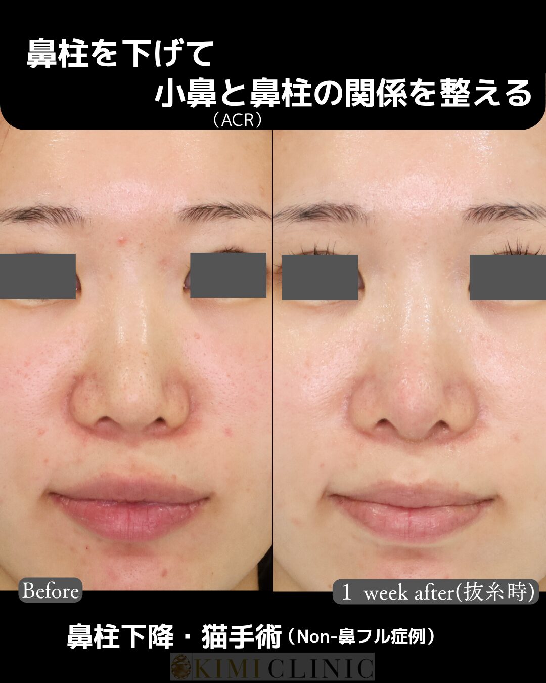 「鼻柱下降＆猫手術」の術前・術後比較Before写真