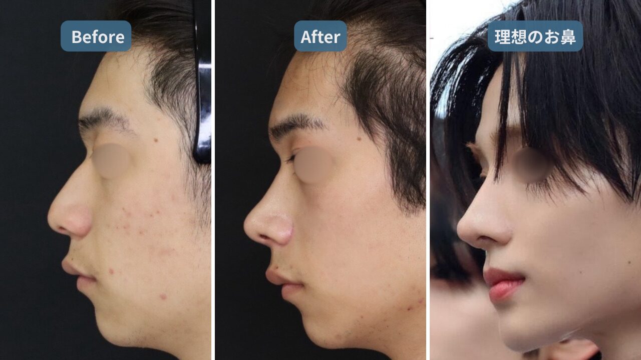 症例解説】【鷲鼻修正×最新術式】プリザベーションライノプラスティで