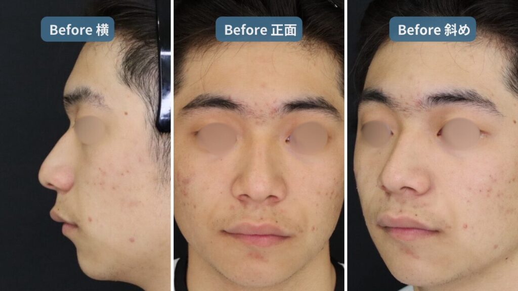 症例解説】【鷲鼻修正×最新術式】プリザベーションライノプラスティで