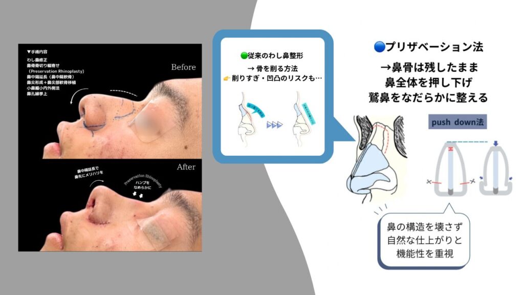 症例解説】【鷲鼻修正×最新術式】プリザベーションライノプラスティで