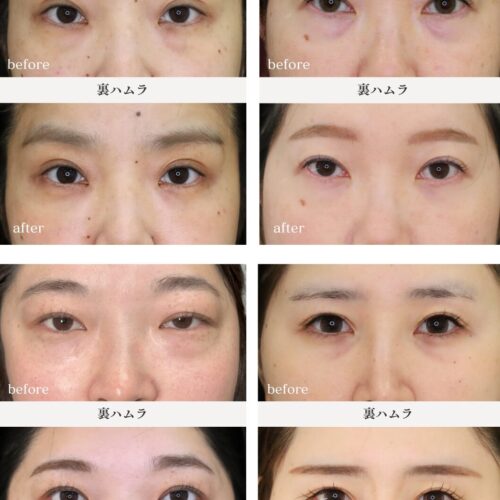 ハムラ法（クマ治療）症例集