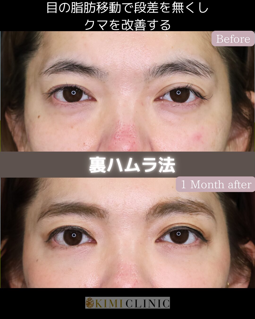 「裏ハムラ法」の術前・術後比較Before写真