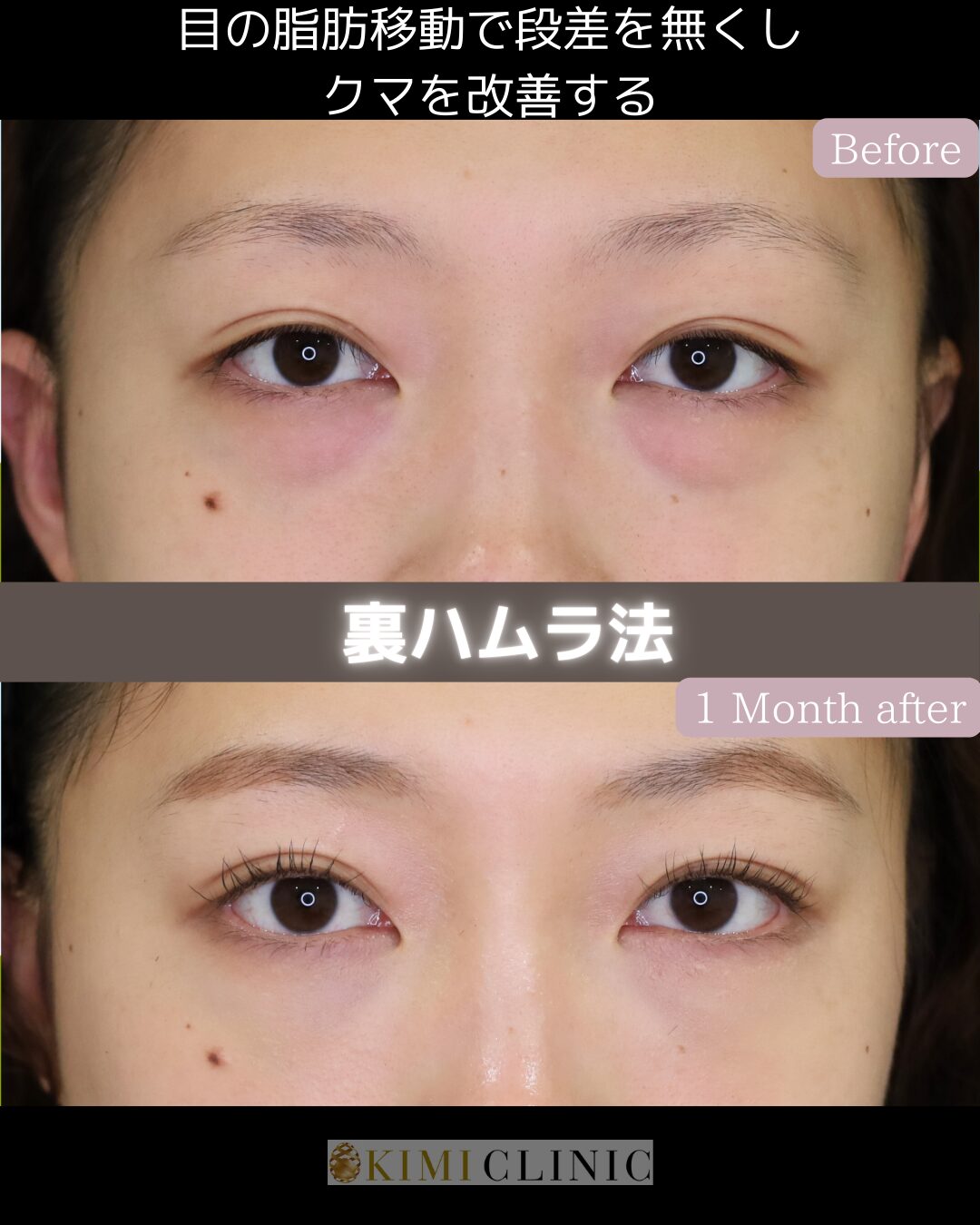 「裏ハムラ法」の術前・術後比較Before写真