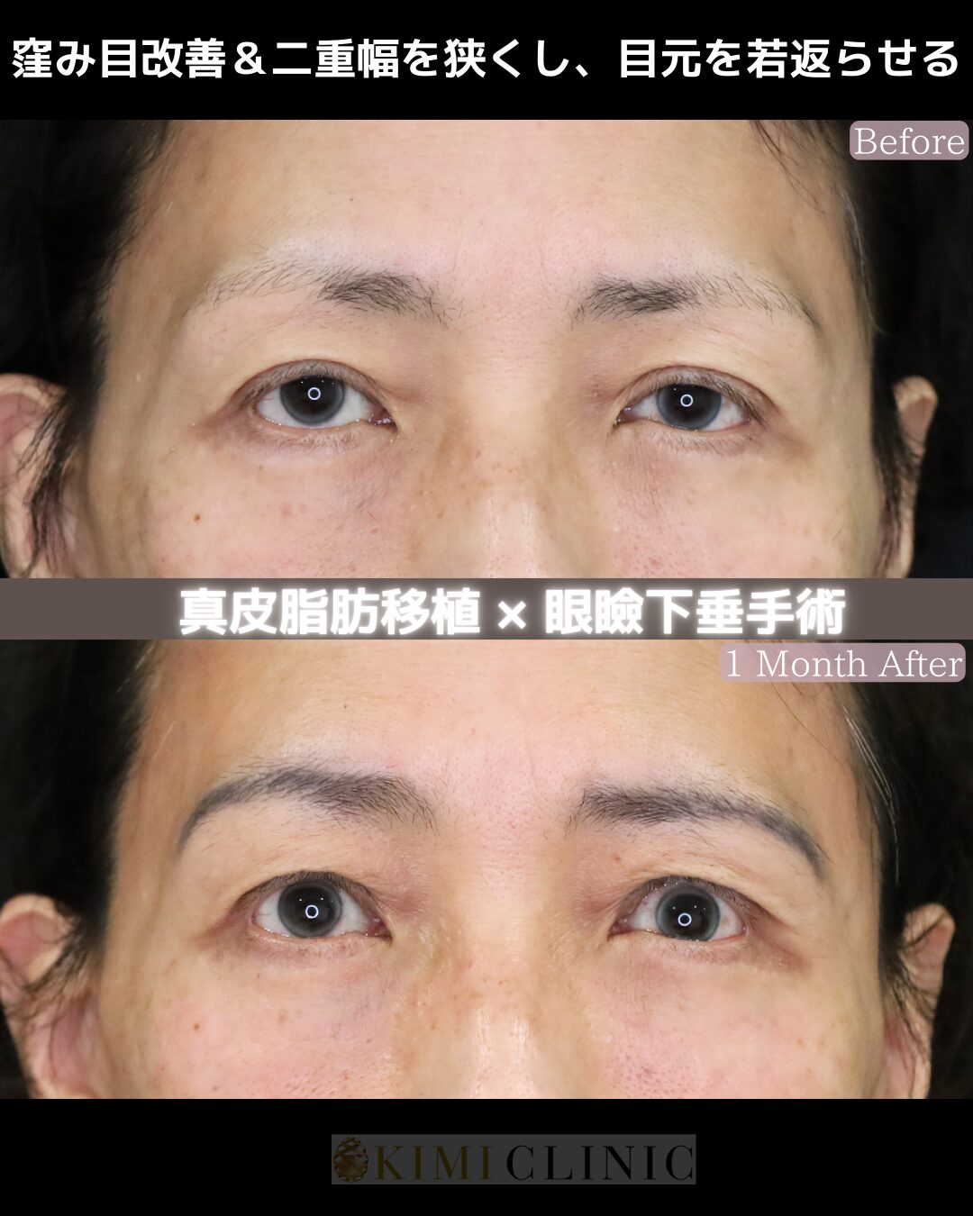 「窪み目改善 × 二重幅を狭める　真皮脂肪移植」の術前・術後比較Before写真